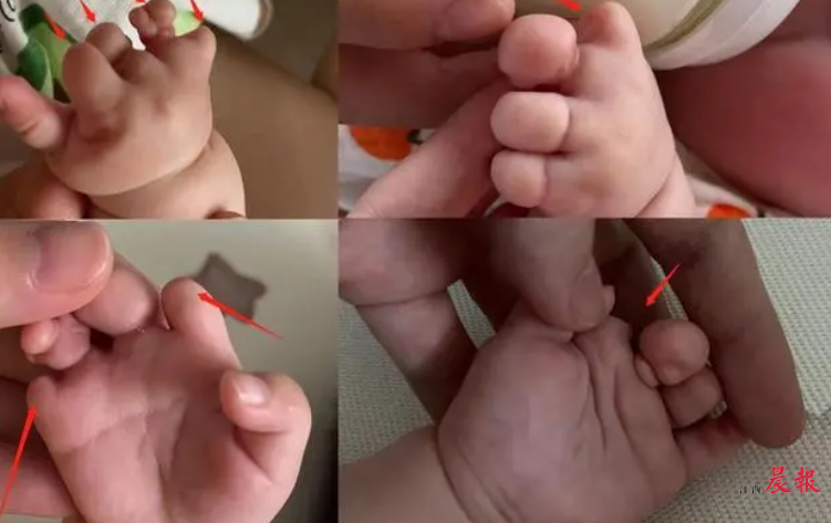 第三代试管婴儿