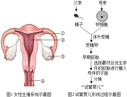 第二代试管婴儿
