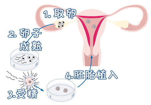 第二代试管婴儿技术