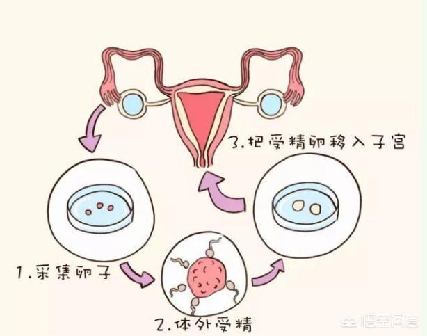 第二代试管婴儿
