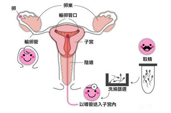 免疫性不孕不育