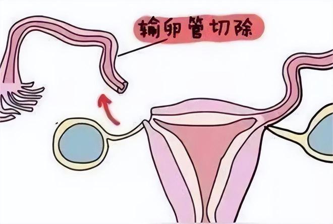 免疫性不孕
